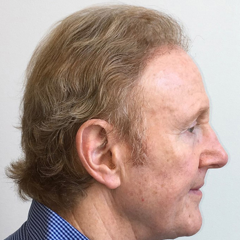 Hair Restoration Removed Photos Deletable 03