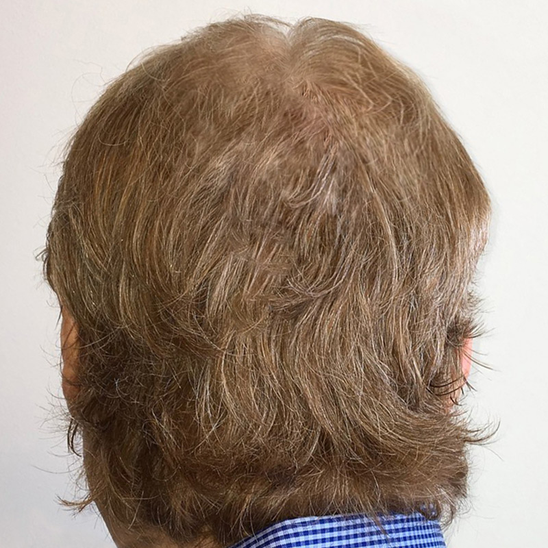 Hair Restoration Removed Photos Deletable 05