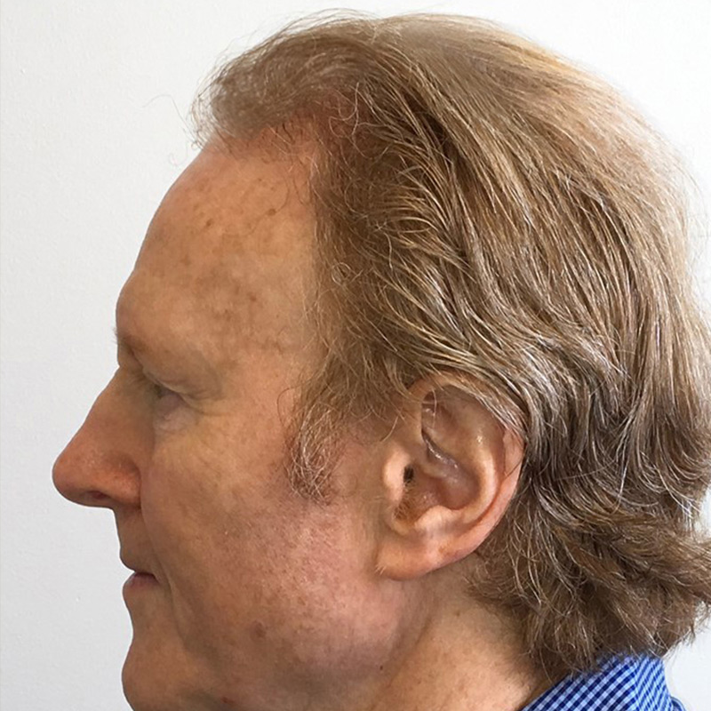 Hair Restoration Removed Photos Deletable 07