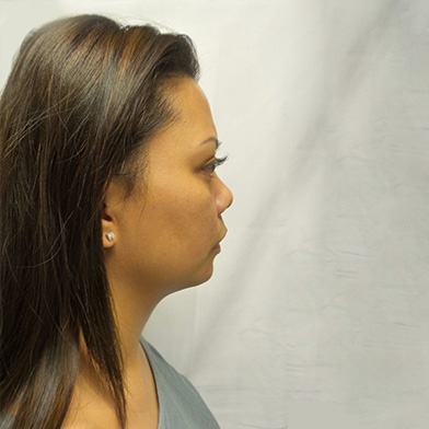 Hair Restoration Removed Photos Deletable 03