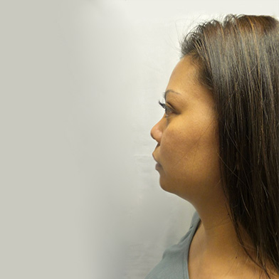 Hair Restoration Removed Photos Deletable 07