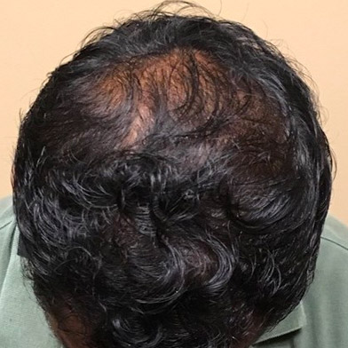 Hair Restoration Removed Photos Deletable 07