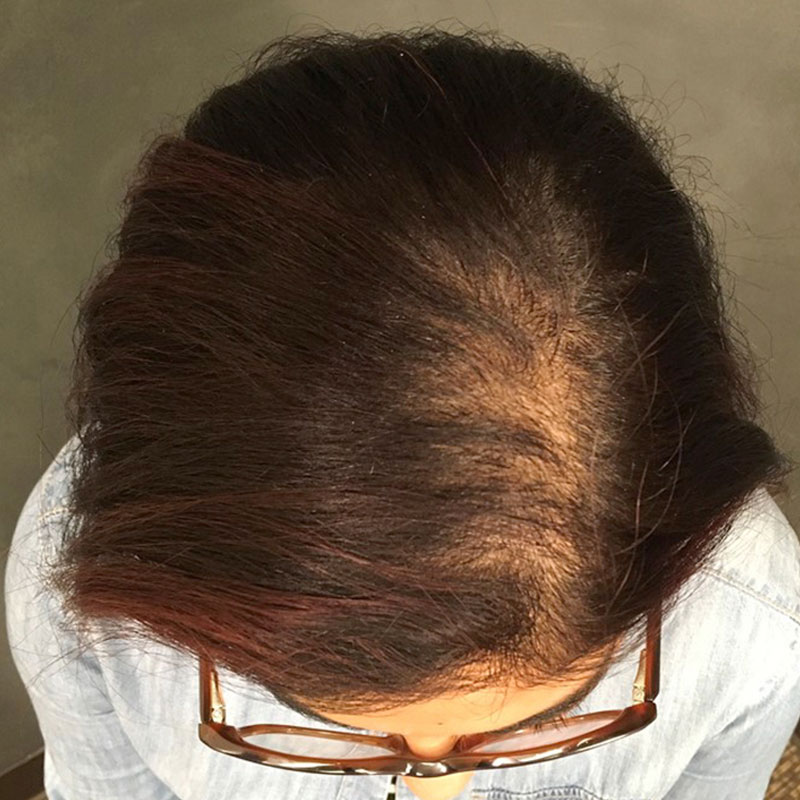 Hair Restoration Removed Photos Deletable 01