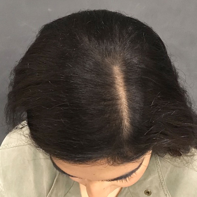 Hair Restoration Removed Photos Deletable 08