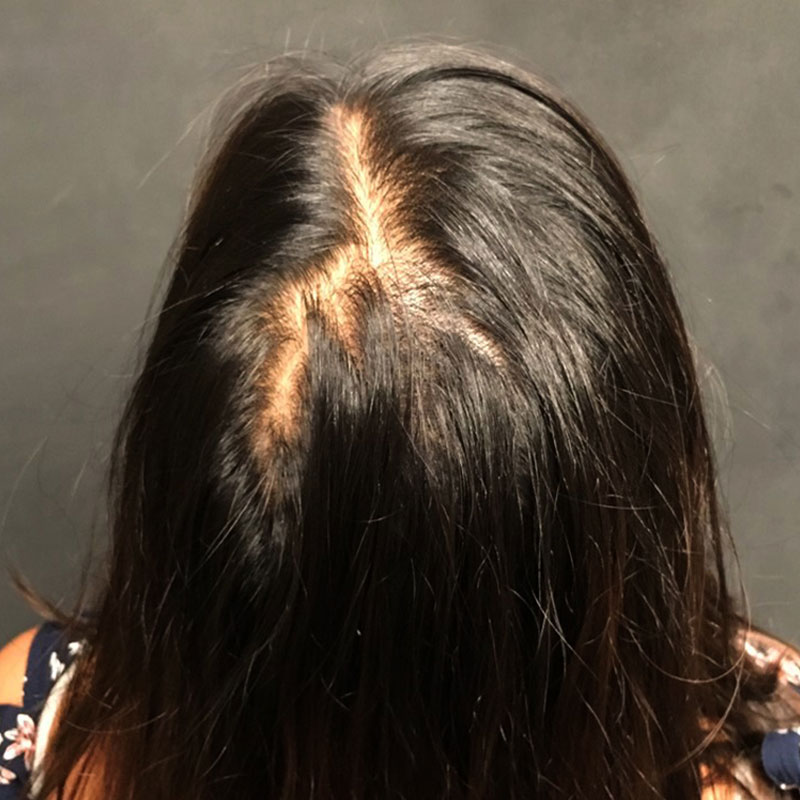 Hair Restoration Removed Photos Deletable 01