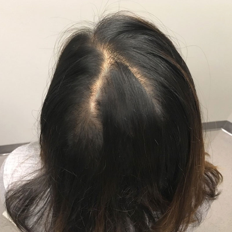 Hair Restoration Removed Photos Deletable 11