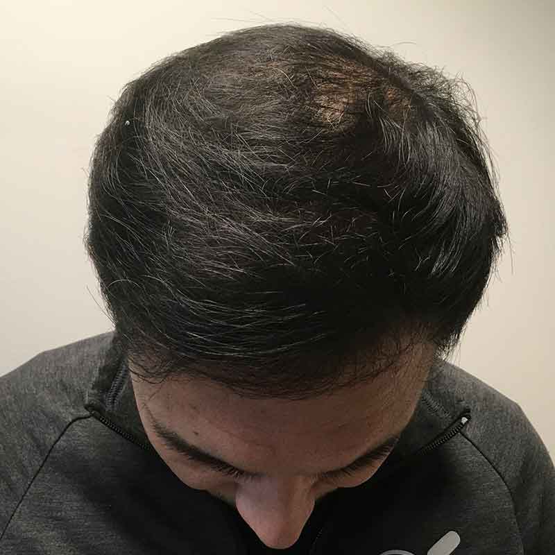 Hair Restoration Removed Photos Deletable 12