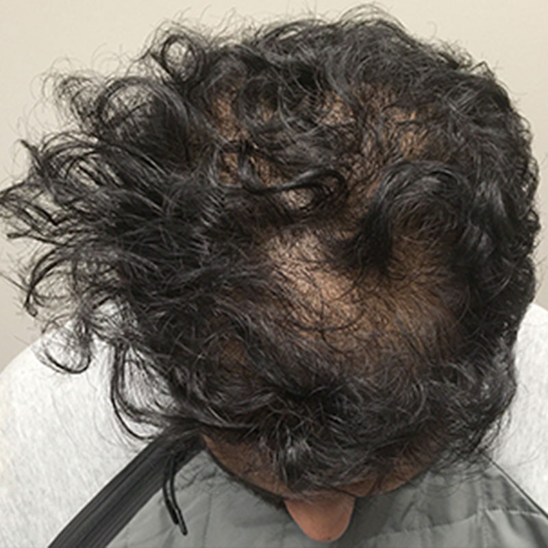 Hair Restoration Removed Photos Deletable 01