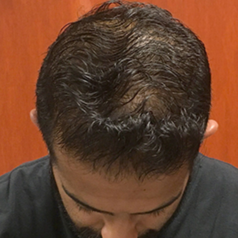 Hair Restoration Removed Photos Deletable 14