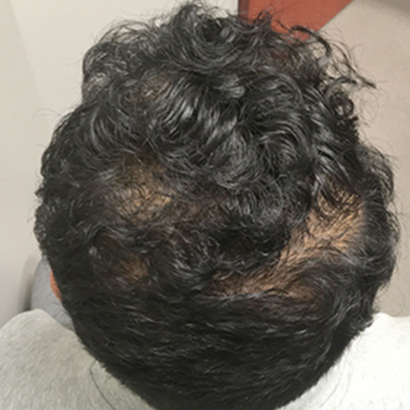 Hair Restoration Removed Photos Deletable 03