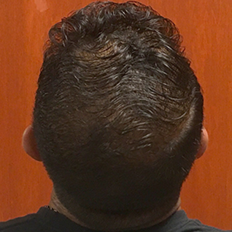 Hair Restoration Removed Photos Deletable 03