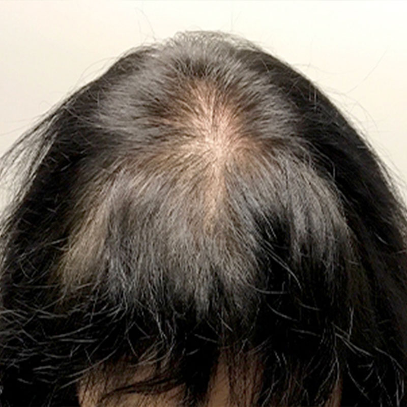 Hair Restoration Removed Photos Deletable 03