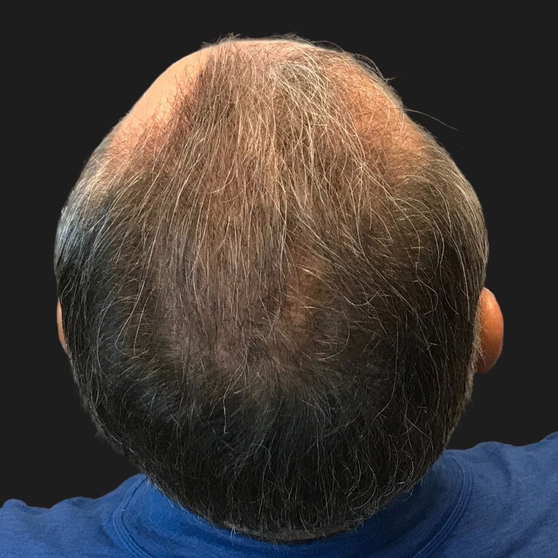 Hair Transplant 03