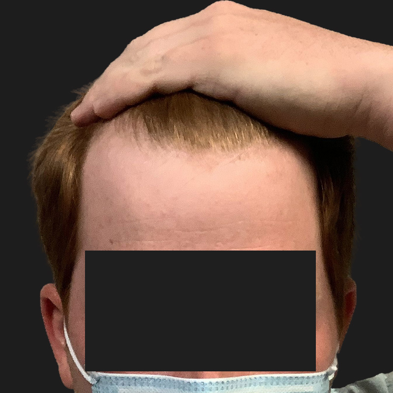 Hair Transplant 01