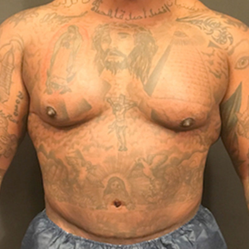 High Definition Liposuction 01