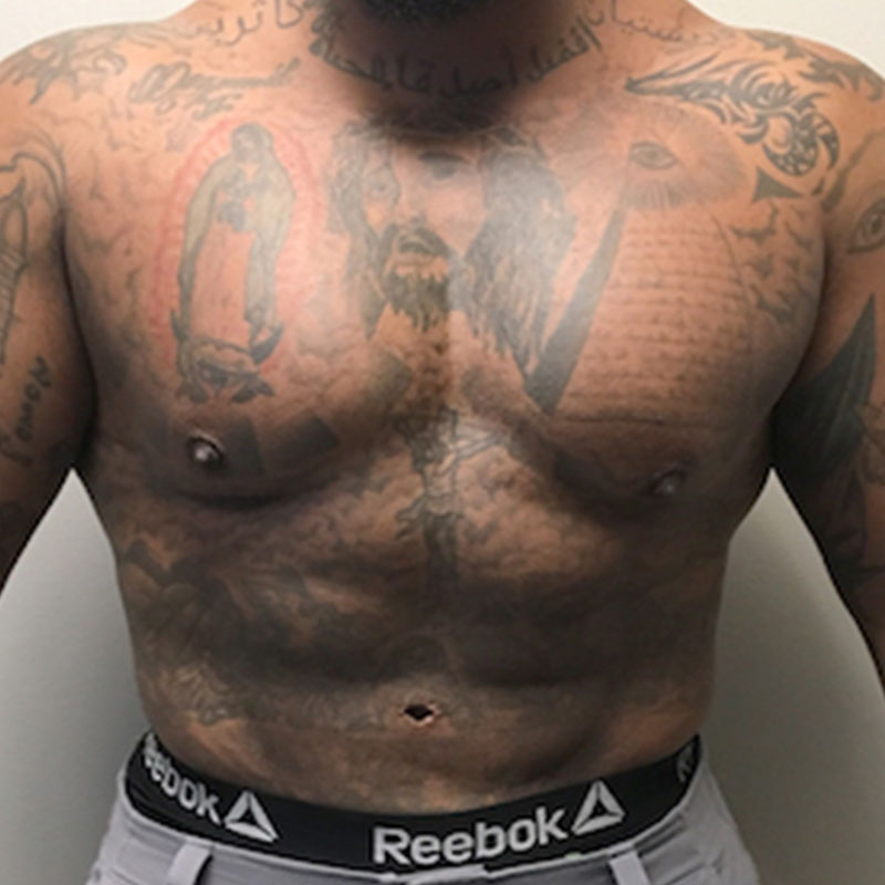 High Definition Liposuction 01