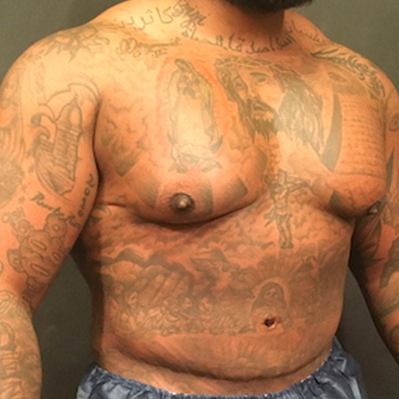 High Definition Liposuction 03