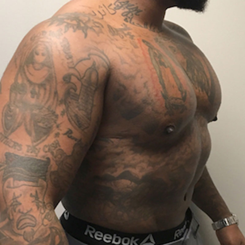 High Definition Liposuction 03