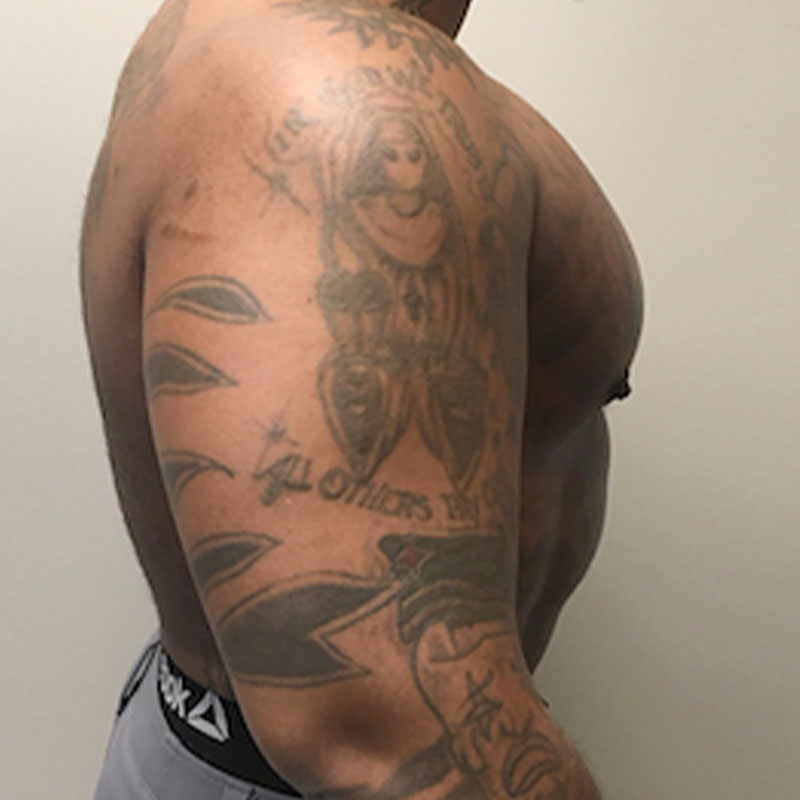 High Definition Liposuction 05