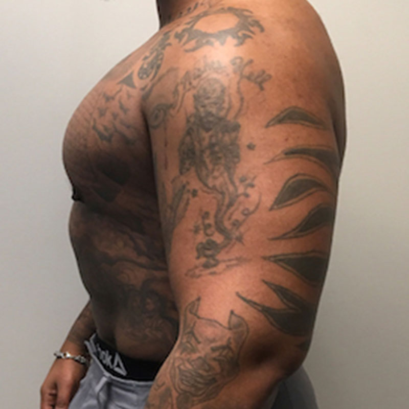 High Definition Liposuction 07