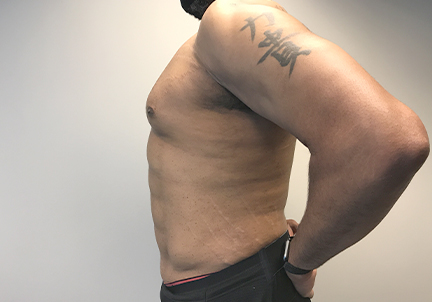 High Definition Liposuction 01