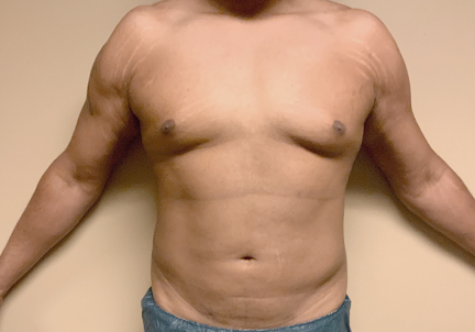 High Definition Liposuction 05