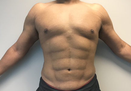 High Definition Liposuction 05