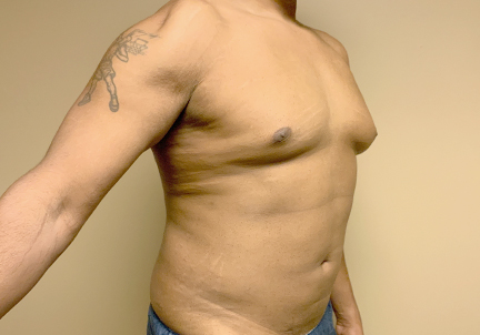 High Definition Liposuction 07