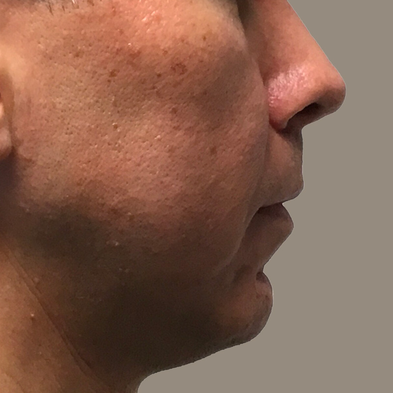 Injectables And Fillers 03