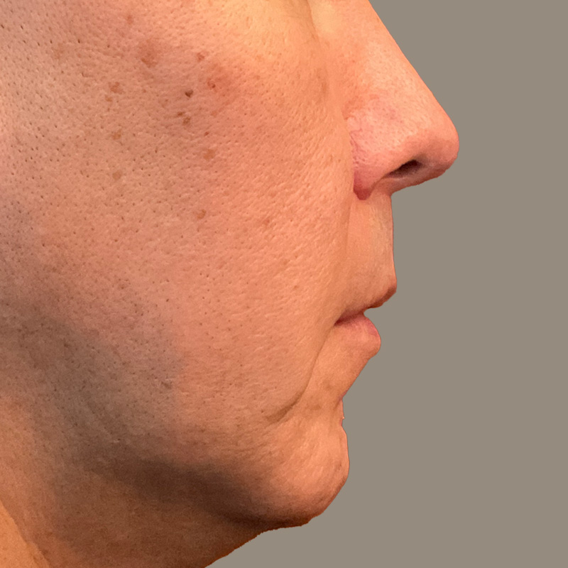 Injectables And Fillers 03