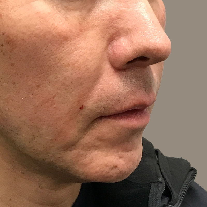 Injectables And Fillers 07