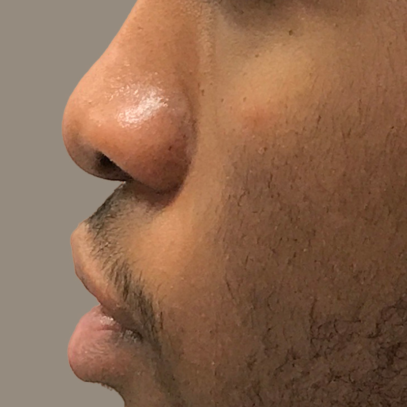 Injectables And Fillers 01