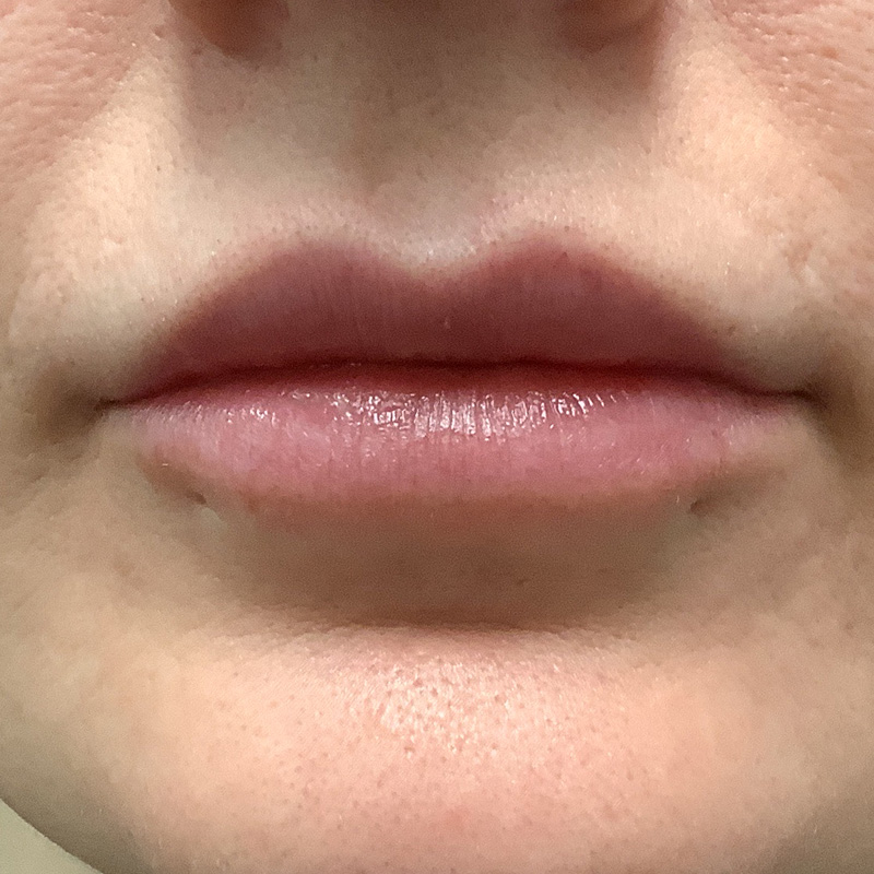 Injectables And Fillers 01