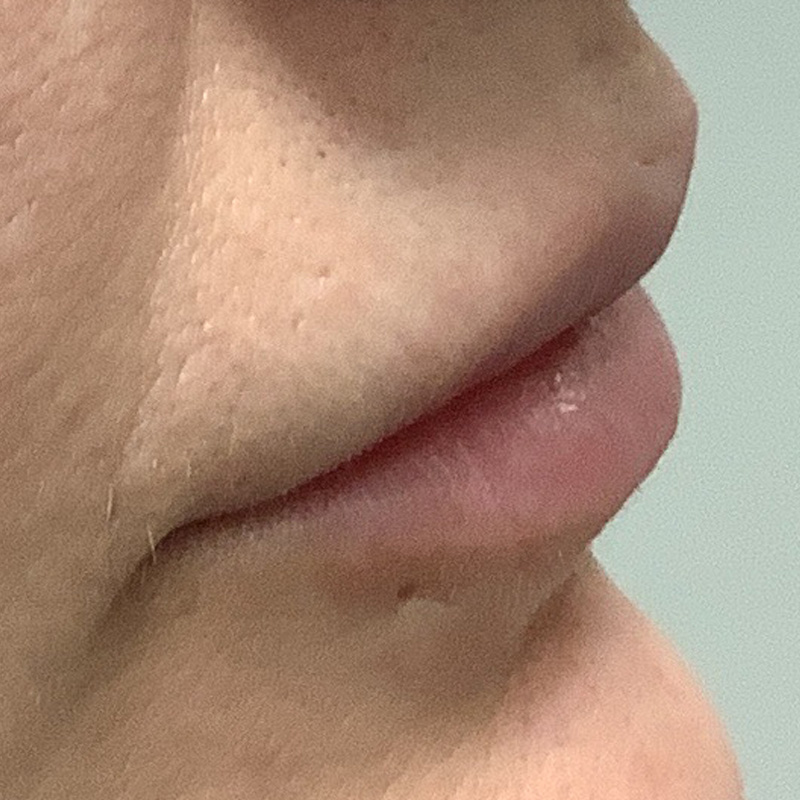 Injectables And Fillers 03