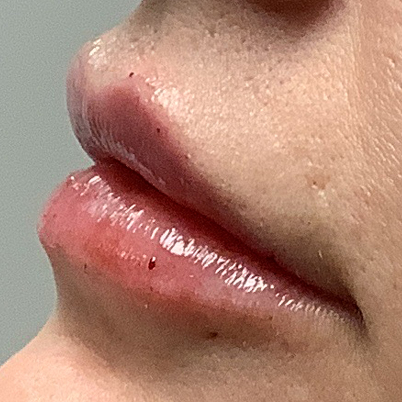 Injectables And Fillers 05