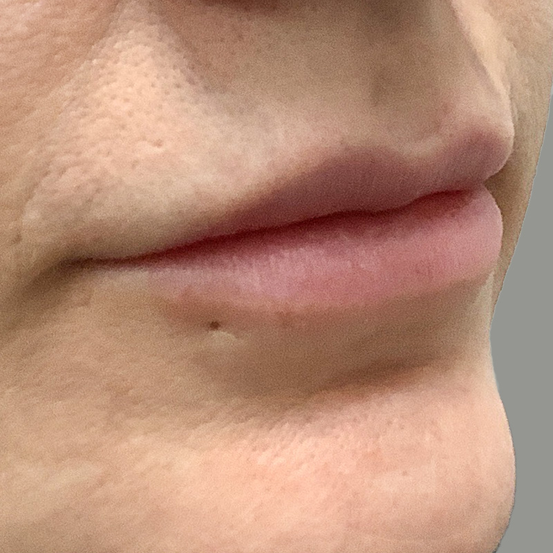 Injectables And Fillers 09