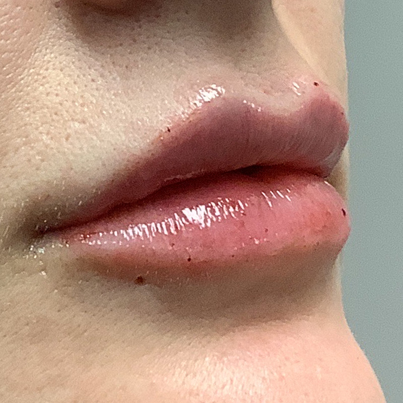 Injectables And Fillers 09