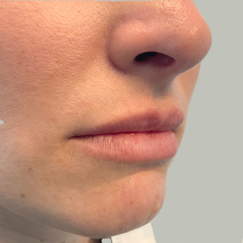 Injectables And Fillers 07