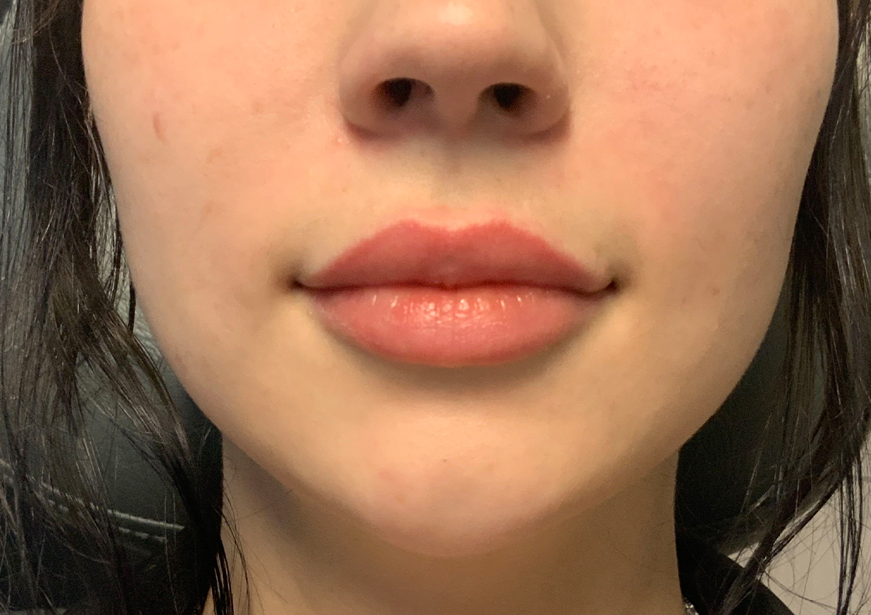 Injectables And Fillers 01