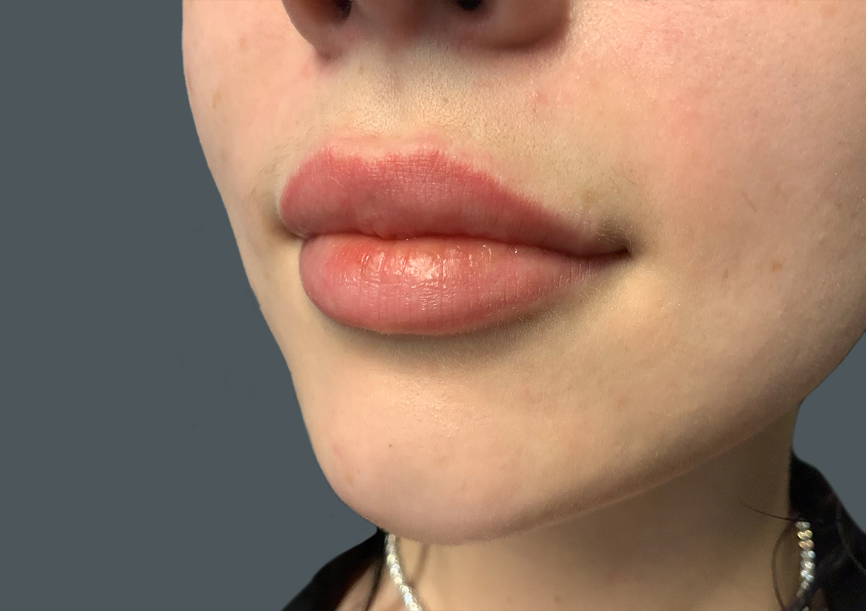 Injectables And Fillers 03