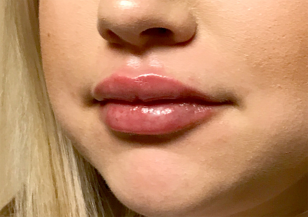 Injectables And Fillers 03