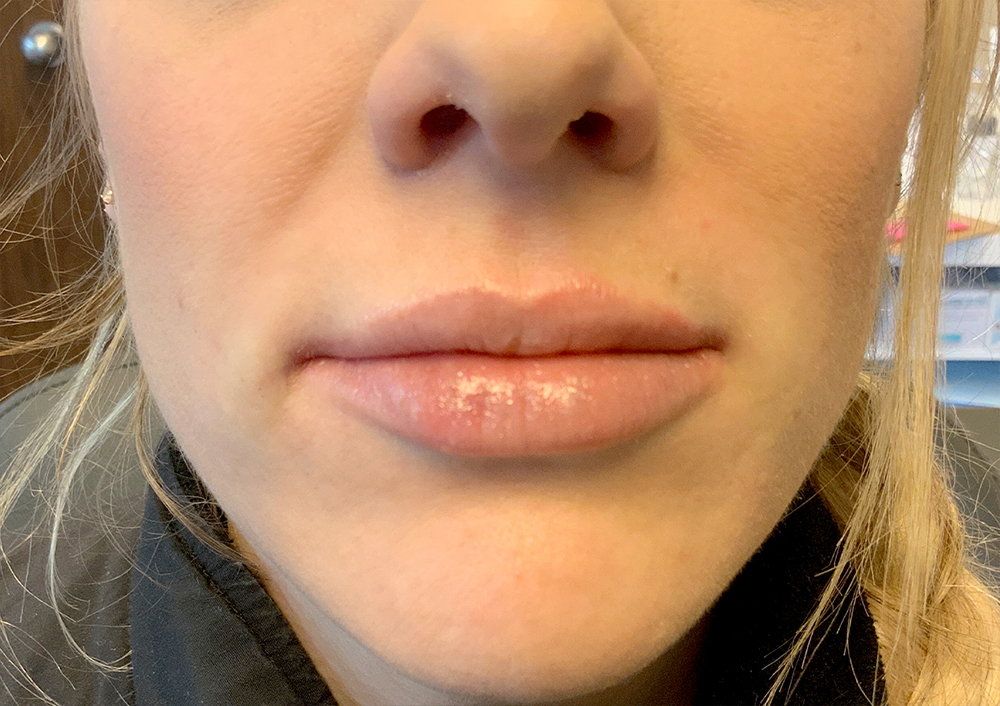 Injectables And Fillers 101