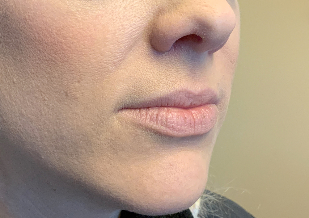 Injectables And Fillers 03