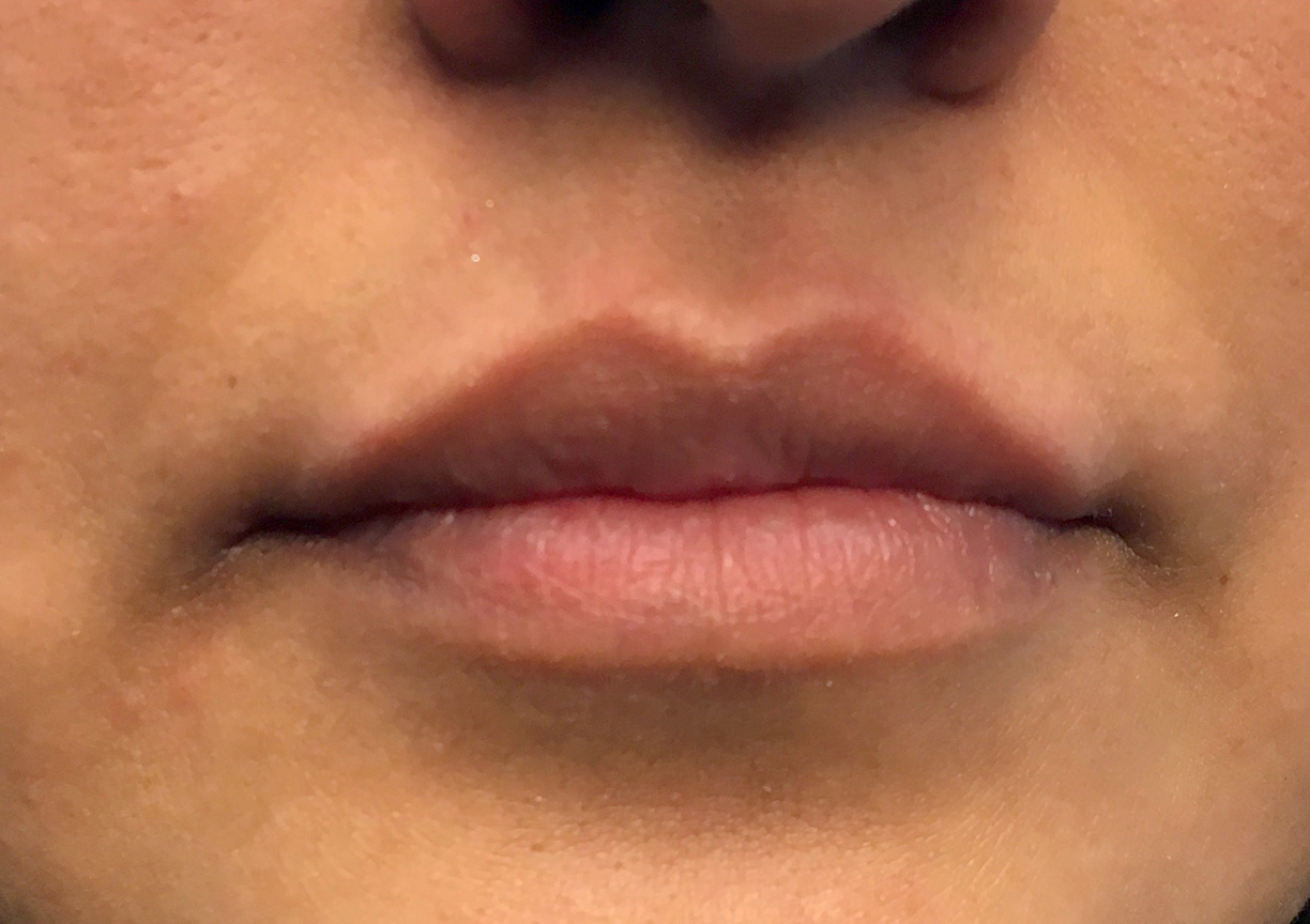 Injectables And Fillers 01