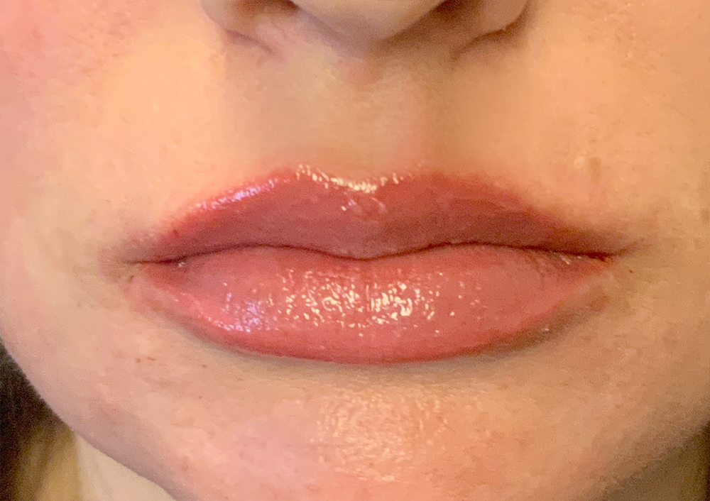 Injectables And Fillers 103