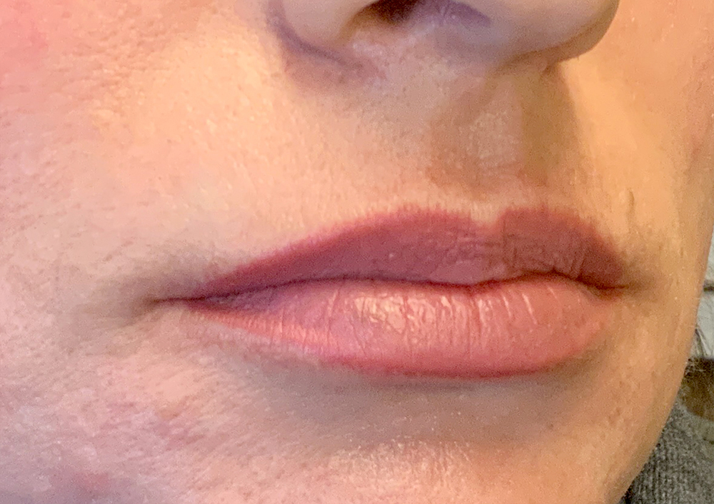 Injectables And Fillers 03