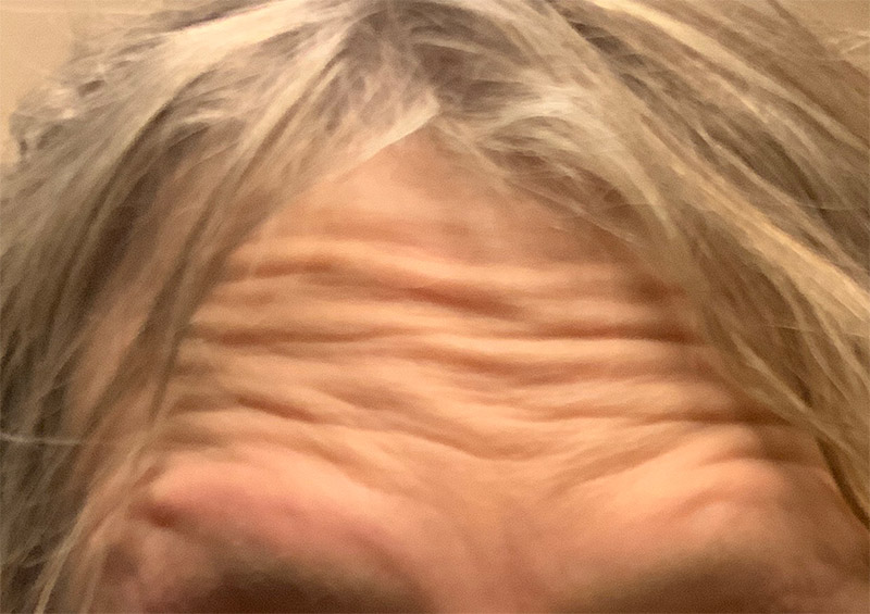 Injectables And Fillers 01