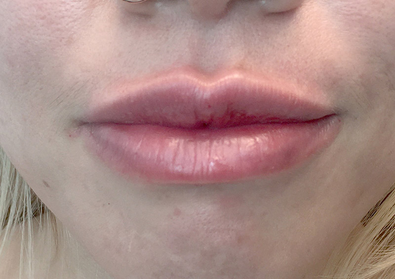 Injectables And Fillers 105