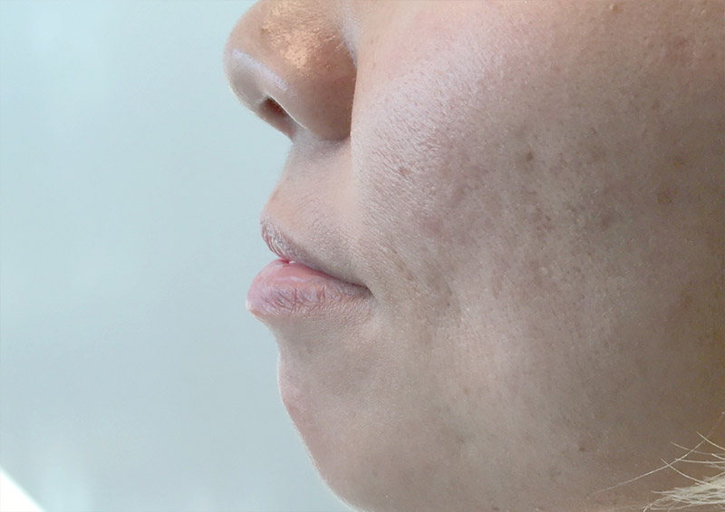 Injectables And Fillers 03