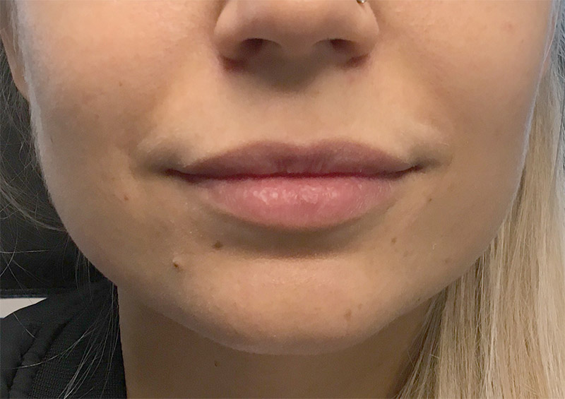 Injectables And Fillers 01